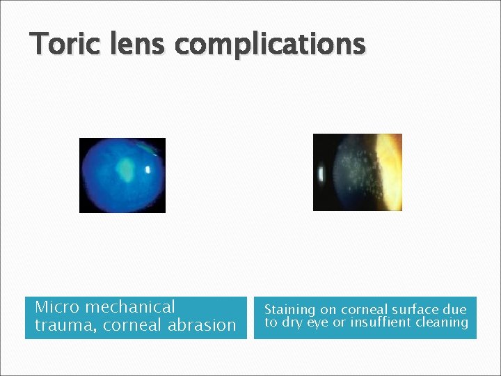 Toric lens complications Micro mechanical trauma, corneal abrasion Staining on corneal surface due to