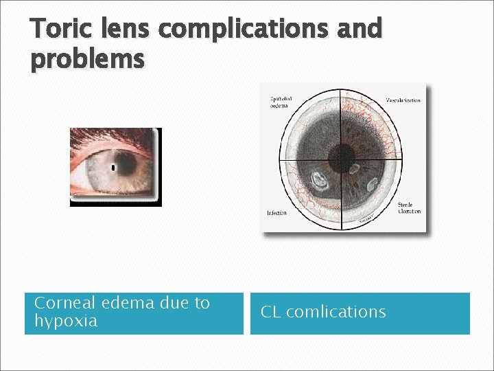 Toric lens complications and problems Corneal edema due to hypoxia CL comlications 