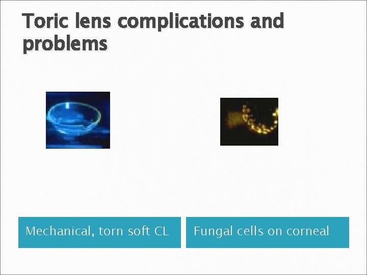 Toric lens complications and problems Mechanical, torn soft CL Fungal cells on corneal 