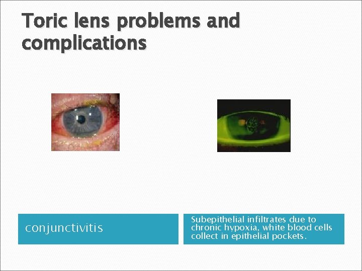 Toric lens problems and complications conjunctivitis Subepithelial infiltrates due to chronic hypoxia, white blood