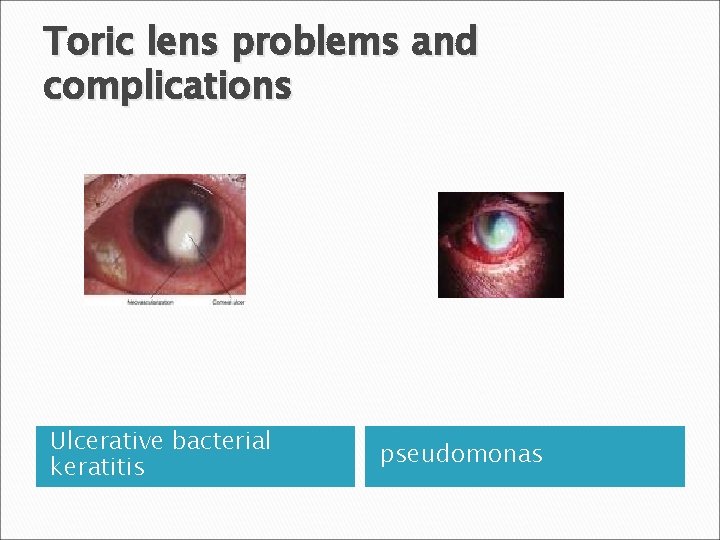 Toric lens problems and complications Ulcerative bacterial keratitis pseudomonas 