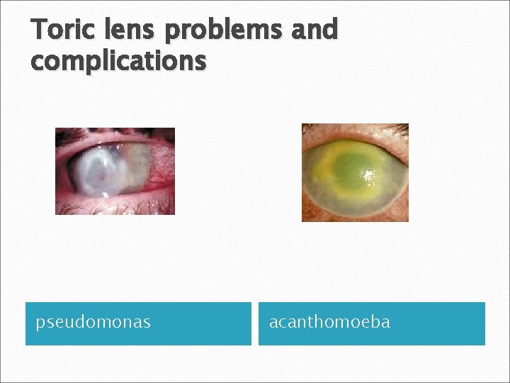 Toric lens problems and complications pseudomonas acanthomoeba 
