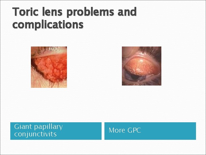 Toric lens problems and complications Giant papillary conjunctivits More GPC 