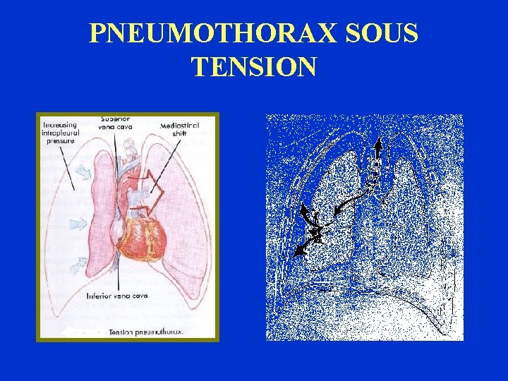 PNEUMOTHORAX SOUS TENSION 