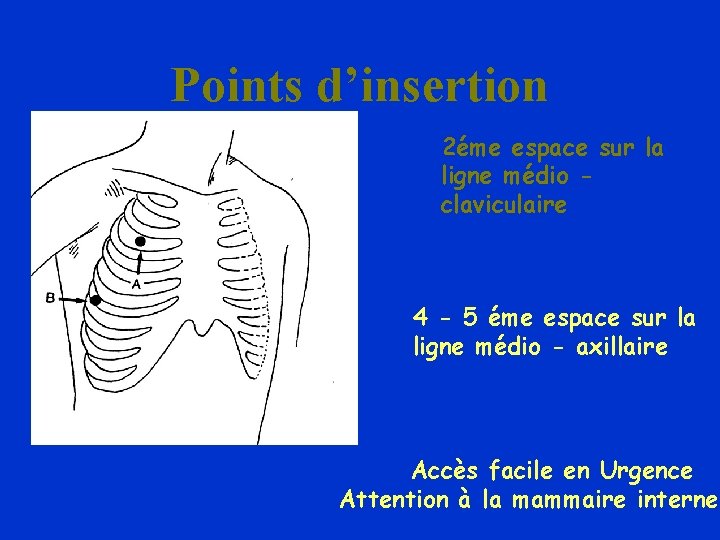 Points d’insertion 2éme espace sur la ligne médio claviculaire 4 - 5 éme espace