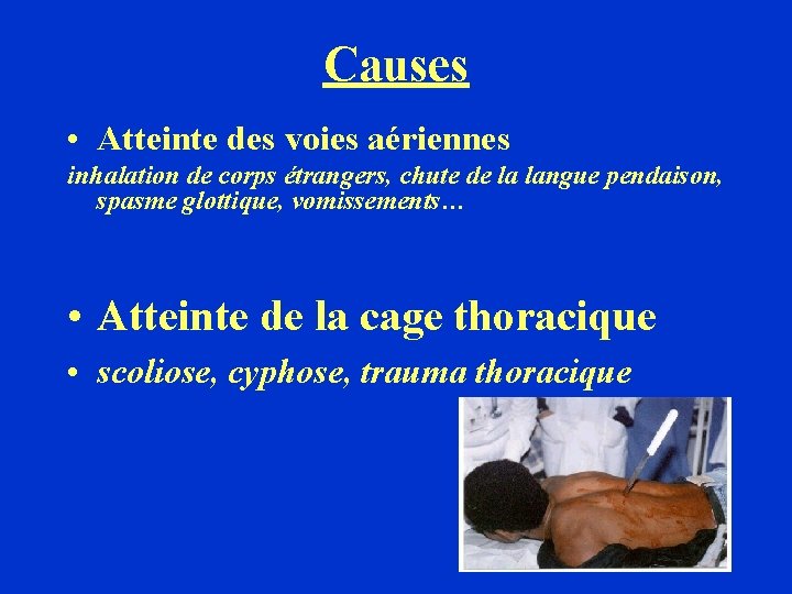 Causes • Atteinte des voies aériennes inhalation de corps étrangers, chute de la langue