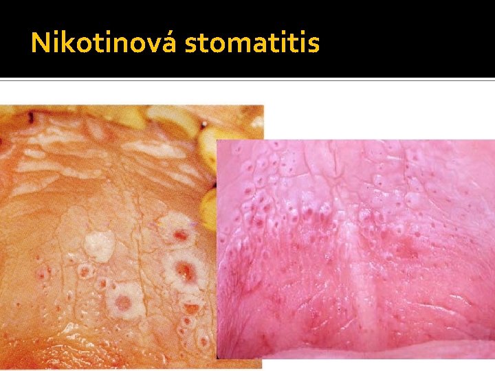 Nikotinová stomatitis 