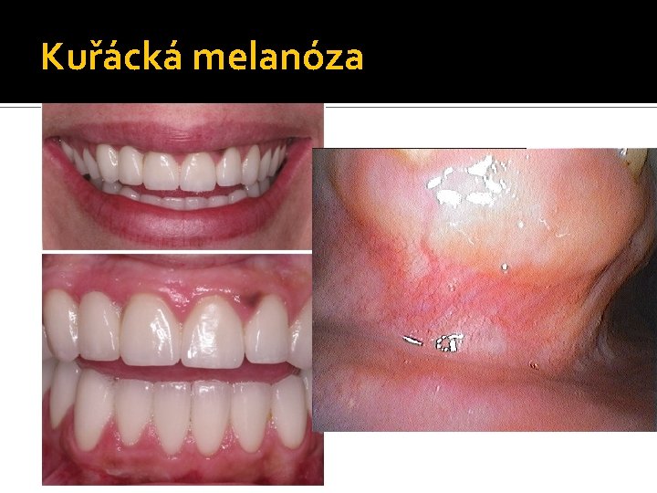 Kuřácká melanóza 