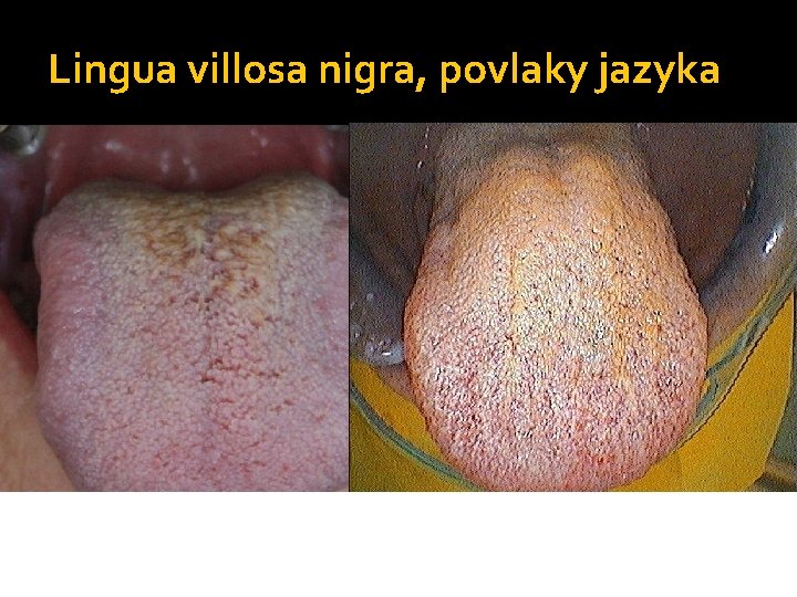 Lingua villosa nigra, povlaky jazyka 