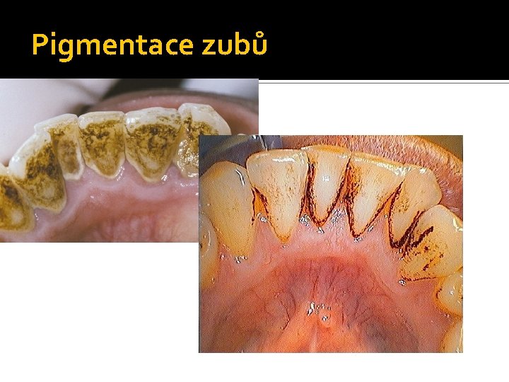 Pigmentace zubů 