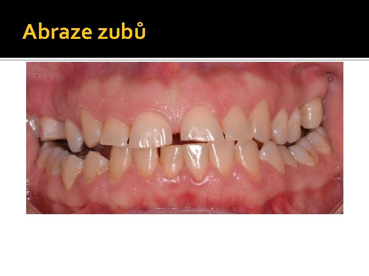 Abraze zubů 