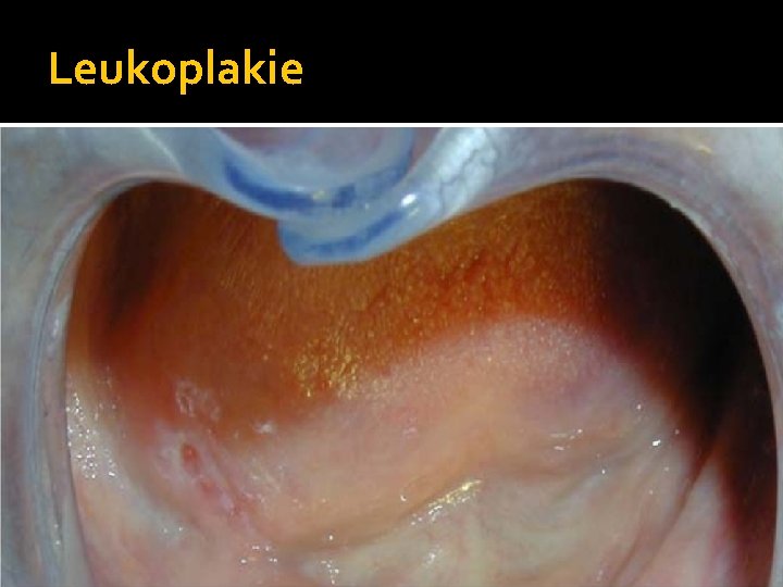 Leukoplakie 
