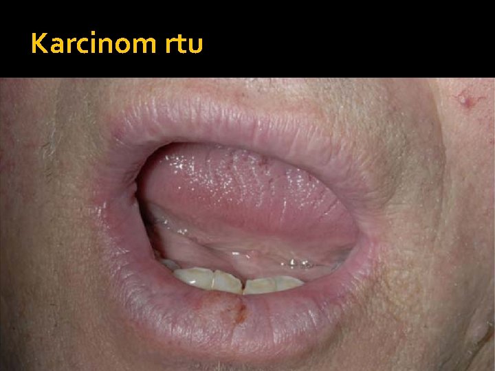 Karcinom rtu 