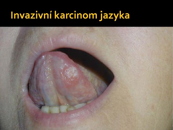 Invazivní karcinom jazyka 
