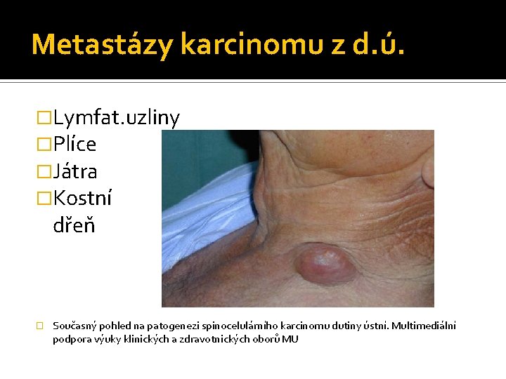 Metastázy karcinomu z d. ú. �Lymfat. uzliny �Plíce �Játra �Kostní dřeň � Současný pohled