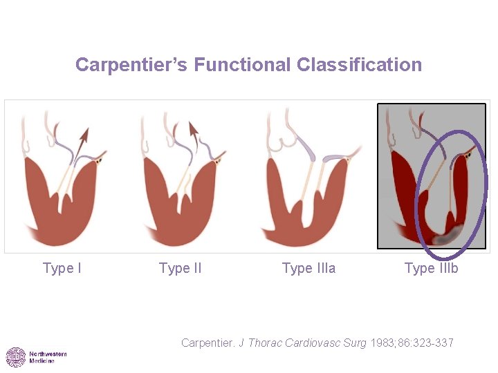 Carpentier’s Functional Classification Type IIIa Type IIIb Carpentier. J Thorac Cardiovasc Surg 1983; 86: