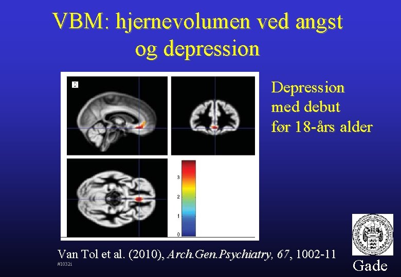 VBM: hjernevolumen ved angst og depression Depression med debut før 18 -års alder Van