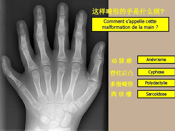 这样畸形的手是什么病? Comment s’appelle cette malformation de la main ? 动脉瘤 Anévrisme 脊柱后凸 Cyphose 多指畸形