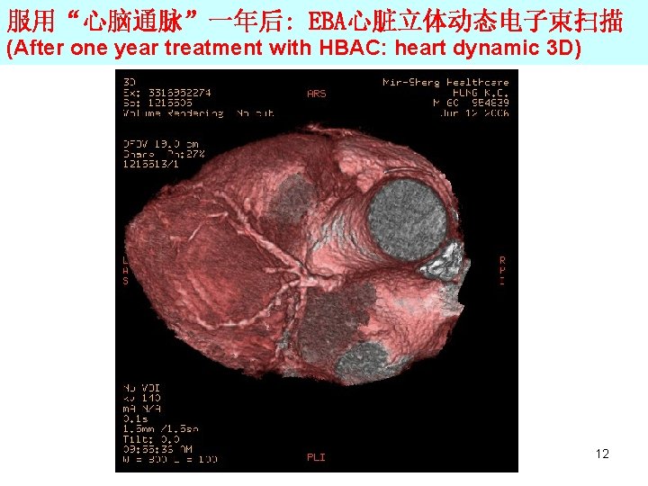 服用“心脑通脉”一年后: EBA心脏立体动态电子束扫描 (After one year treatment with HBAC: heart dynamic 3 D) 12 