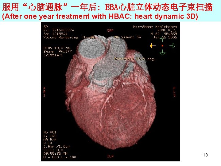 服用“心脑通脉”一年后: EBA心脏立体动态电子束扫描 (After one year treatment with HBAC: heart dynamic 3 D) 13 