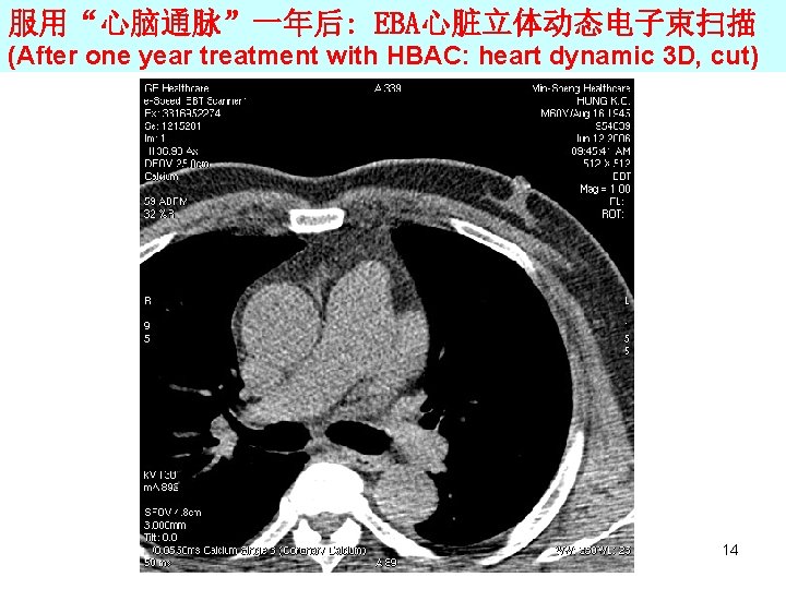 服用“心脑通脉”一年后: EBA心脏立体动态电子束扫描 (After one year treatment with HBAC: heart dynamic 3 D, cut) 14