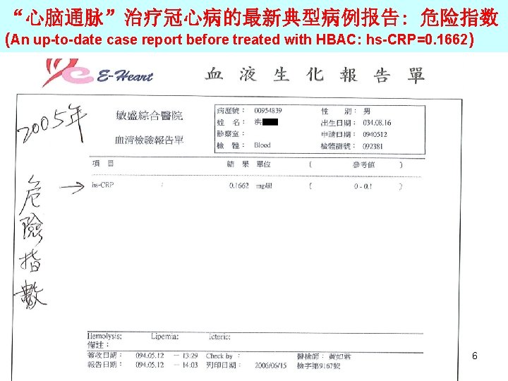 “心脑通脉”治疗冠心病的最新典型病例报告: 危险指数 (An up-to-date case report before treated with HBAC: hs-CRP=0. 1662) 6 