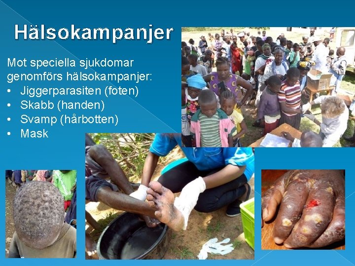 Hälsokampanjer Mot speciella sjukdomar genomförs hälsokampanjer: • Jiggerparasiten (foten) • Skabb (handen) • Svamp