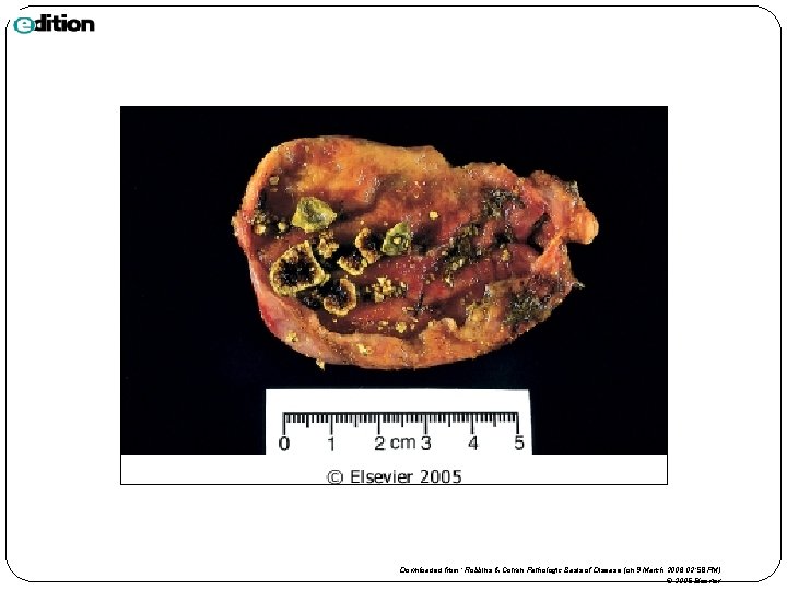 Downloaded from: Robbins & Cotran Pathologic Basis of Disease (on 9 March 2006 02: