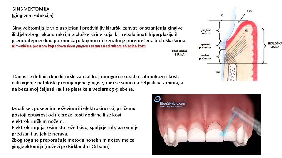 GINGIVEKTOMIJA (gingivna redukcija) Gingivektomija je vrlo uspješan i predvidljiv kirurški zahvat odstranjenja gingive ili