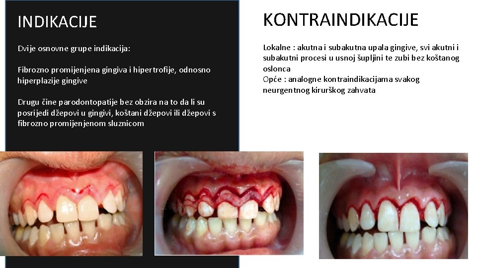 INDIKACIJE KONTRAINDIKACIJE Dvije osnovne grupe indikacija: Lokalne : akutna i subakutna upala gingive, svi