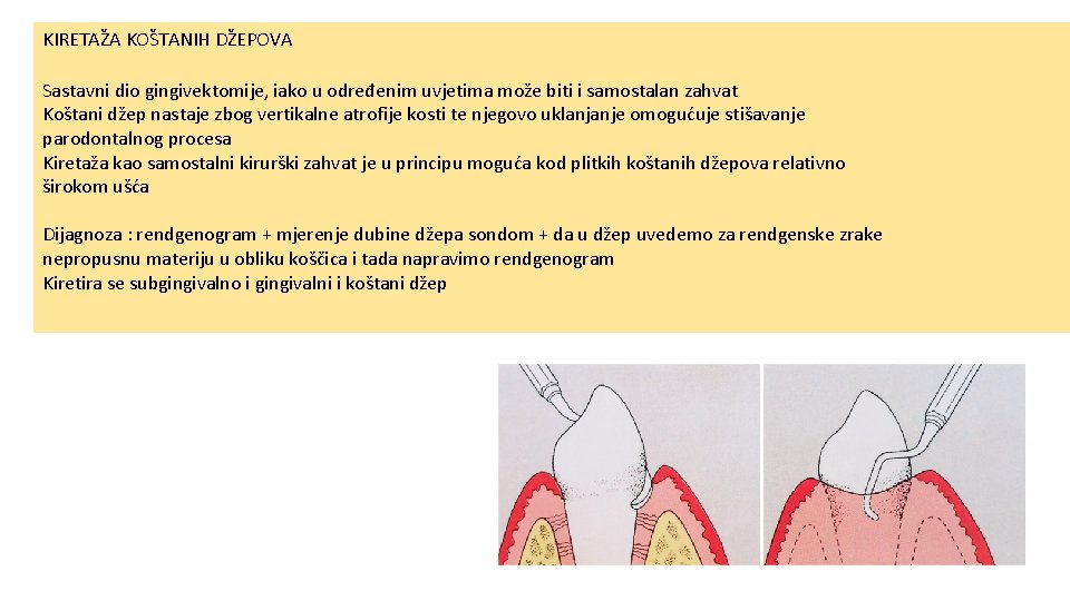 KIRETAŽA KOŠTANIH DŽEPOVA Sastavni dio gingivektomije, iako u određenim uvjetima može biti i samostalan