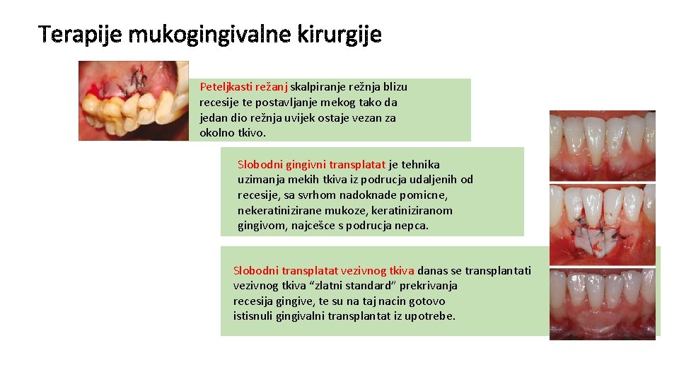 Peteljkasti režanj skalpiranje režnja blizu recesije te postavljanje mekog tako da jedan dio režnja