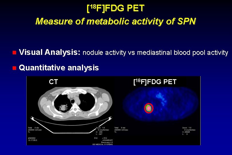 [18 F]FDG PET Measure of metabolic activity of SPN Visual Analysis: nodule activity vs
