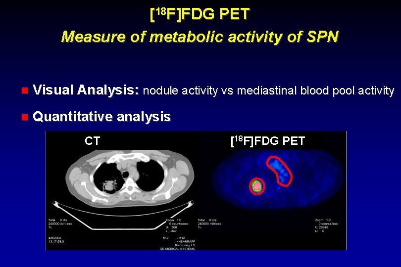 [18 F]FDG PET Measure of metabolic activity of SPN Visual Analysis: nodule activity vs