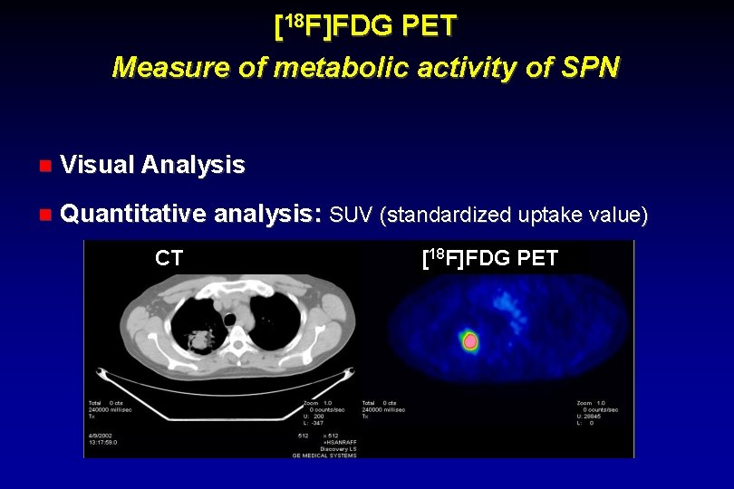 [18 F]FDG PET Measure of metabolic activity of SPN Visual Analysis Quantitative analysis: SUV