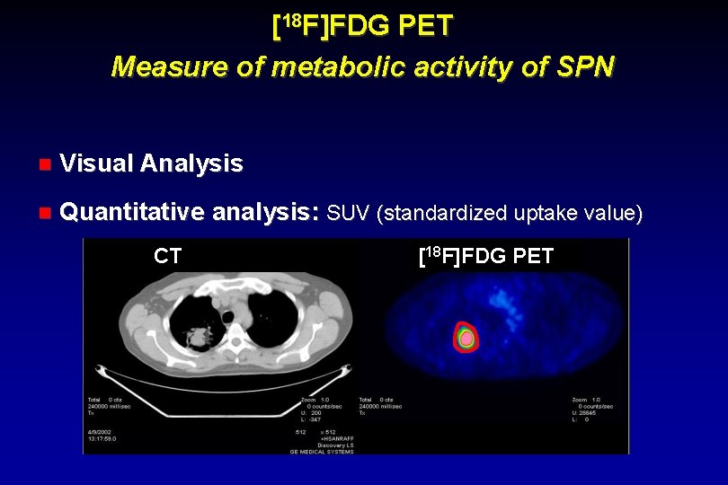 [18 F]FDG PET Measure of metabolic activity of SPN Visual Analysis Quantitative analysis: SUV