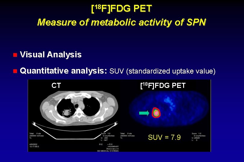 [18 F]FDG PET Measure of metabolic activity of SPN Visual Analysis Quantitative analysis: SUV