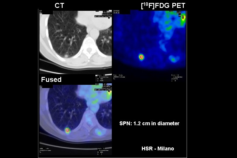 CT [18 F]FDG PET Fused SPN: 1. 2 cm in diameter HSR - Milano