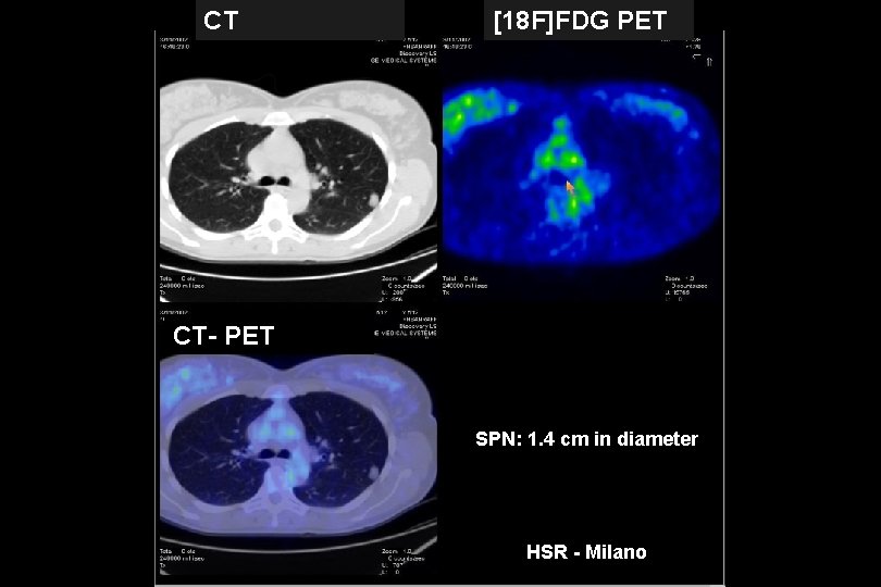 CT [18 F]FDG PET CT- PET SPN: 1. 4 cm in diameter HSR -