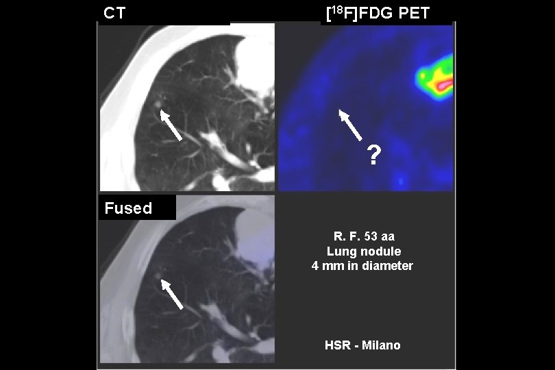 CT [18 F]FDG PET ? Fused R. F. 53 aa Lung nodule 4 mm