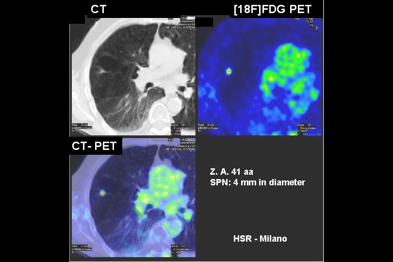 CT [18 F]FDG PET CT- PET Z. A. 41 aa SPN: 4 mm in