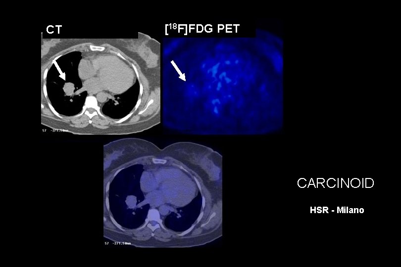 CT [18 F]FDG PET CARCINOID HSR - Milano 