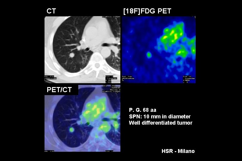 CT [18 F]FDG PET/CT P. G. 68 aa SPN: 10 mm in diameter Well