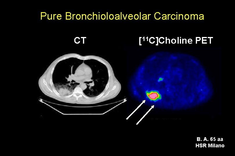 Pure Bronchioloalveolar Carcinoma CT 18 F]FDG PET [11[C]Choline PET SUV = 1. 73 B.