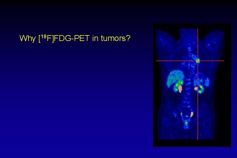 Why [18 F]FDG-PET in tumors? 