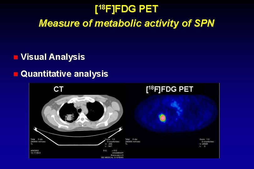 [18 F]FDG PET Measure of metabolic activity of SPN Visual Analysis Quantitative analysis CT