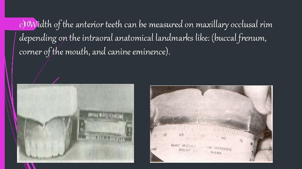 c)10 Width of the anterior teeth can be measured on maxillary occlusal rim depending