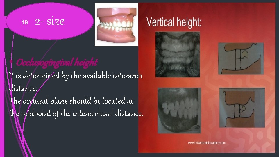 19 2 - size • Occlusogingival height It is determined by the available interarch