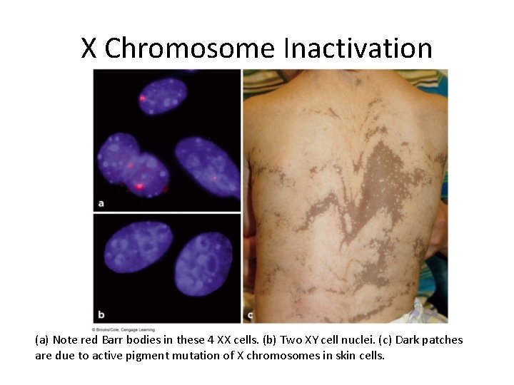 X Chromosome Inactivation (a) Note red Barr bodies in these 4 XX cells. (b)