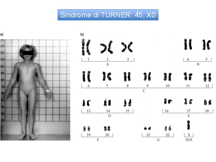 Sindrome di TURNER: 45, X 0 